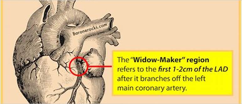 Widow maker artery images